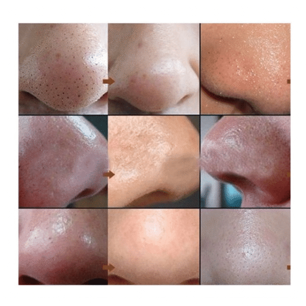 REMOVE BLACKHEADS DESINCRUSTATION SOLUTION (400ML)